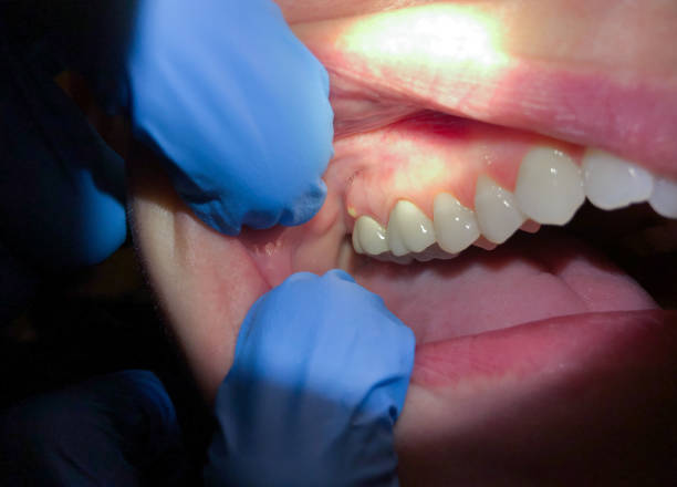 Best Tooth Infection Emergency Dentist  in Boise City, OK